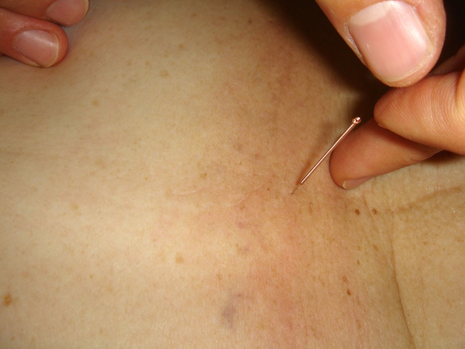 acupuncture-289251_960_720.jpg